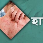 হামের উপসর্গে ২৪ ঘণ্টায় আরও ৫ মৃত্যু, নতুন আক্রান্ত ১,১১০